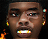 Vitiligo Odell.