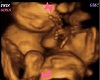 GMC Twin Girl 7M UltraSo