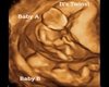 12 week Ultrasound Twins