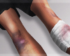 ᄊ Synet Injury Legs.