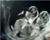 twins ultrasound
