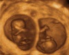 Sonogram Twins 11 wks