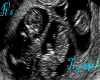 Male Triplets Ultrasound