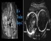 Twin Boys Ultrasound