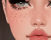 Freckles