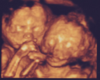 Ultrasound Picture Twins