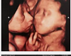 l3lunts Ultrasound