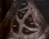 quints ultrasound