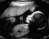 Babygirl's Sonogram Pic