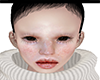 FionaHyperpigmentation