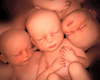 ultrasound triplets