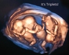 It's Triplets Ultrasound