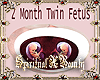 2 Month Twins In Tummy