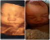 Before/After Ultrasound