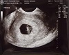 newborn fetus ultrasound