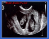 Maulo Twins ultrasound